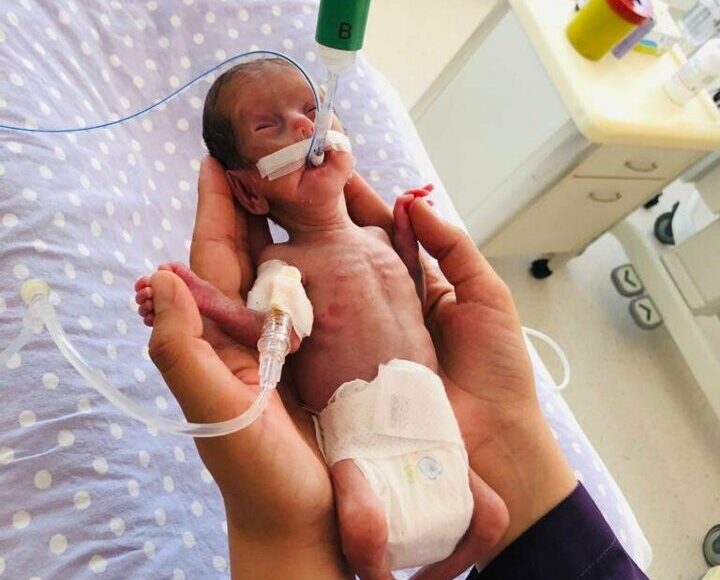 ولادة طفلة لم تكمل الـ 6 أشهر بوزن 520 غراماً في قونية